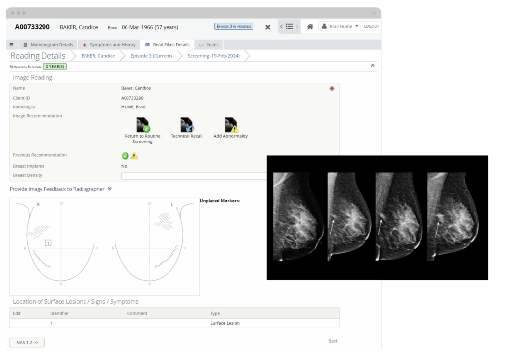 Screenshot of Orion Health Breast Screening solution's Double Blind reading feature
